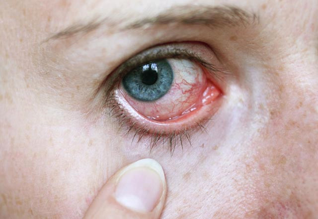 Gözlerinizdeki Kaşıntı ve Batmalara Dikkat! Göz Taşı Nedir, Nasıl Tedavi Edilir?