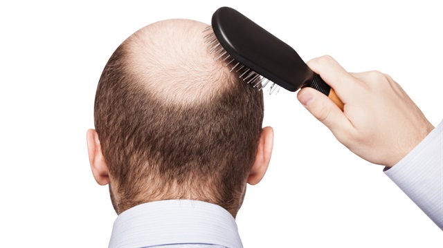 PRP İle Saç Dökülmesi Tedavisi