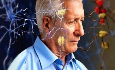 Alzheimer Riski 65 Yaşından Sonra Yükseliyor