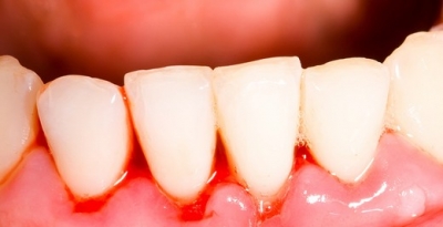 Dişlerinizi Kaybetmek İstemiyorsanız Diş Eti Kanamalarını Ciddiye Alın!