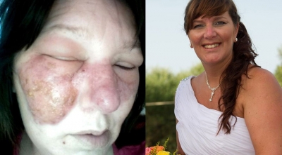 Yüzünü Kaşıdı, Ölümcül Enfeksiyon Kaptı! Sadece Bir Kaşıma Yüzünden Hayatını Kaybedebilir